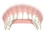 Perfect Smile clinical steps for Nobel Guide